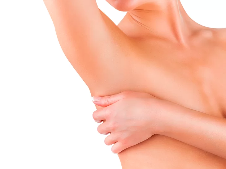 Na imagem há uma mulher branca com um dos braços erguidos, enquanto sua outra mão toca suas axilar, mostrando que o suor excessivo que ela possuía pode ser tratado. Atrás da mulher há uma parede branca.