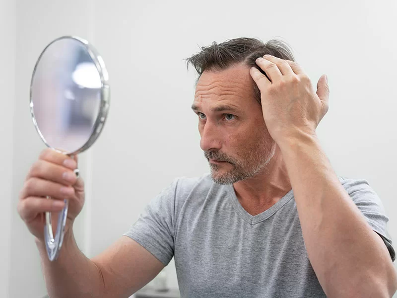 A imagem mostra um homem adulto, de pele e cabelos claros, segurando um espelho redondo de mão sobre a cabeça com a mão direita. Ele está olhando para cima, em direção ao espelho e, com a mão esquerda, revela uma falha de cabelos no couro cabeludo. Veste uma blusa cinza e o fundo da imagem é branco.