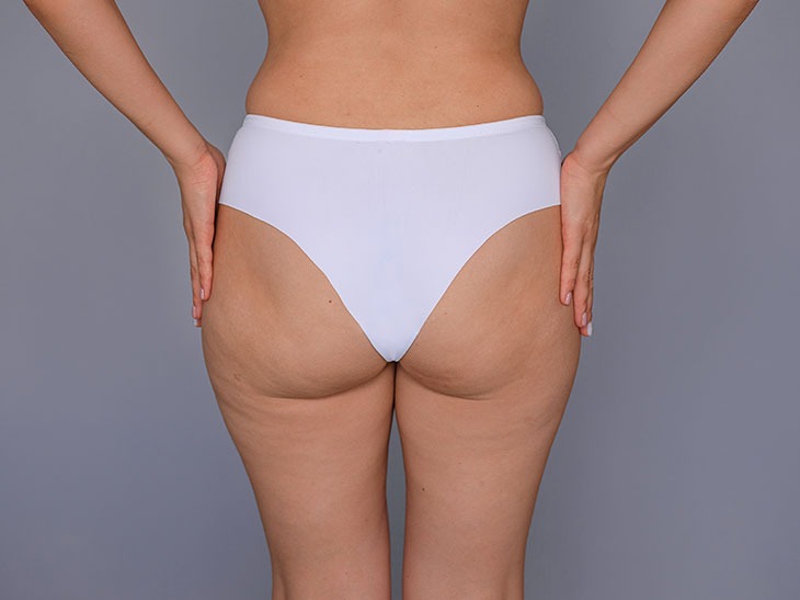Ao centro da imagem é possível visualizar uma mulher caucasiana, de costas. Ela veste uma calcinha branca e tem algumas celulites nas pernas e no bumbum. Ela está com as mãos apoiadas no quadril