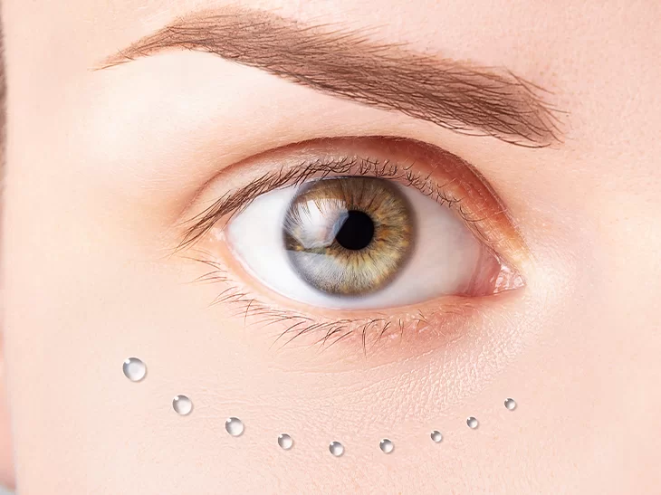 Blefaroplastia realizada na Clínica Dra. Sheila Matielo em Passo Fundo, cirurgia das pálpebras superior e inferior.