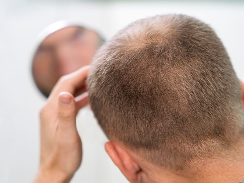 A imagem mostra um homem de costas se olhando em um espelho. O foco está em sua cabeça, mostrando áreas de calvície que podem ser percebidos no espelho.
